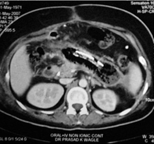 CT Scan of Infected Pancreatic necrosis