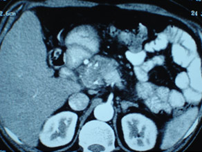 CT of pancreatic head mass showing stipled calcification