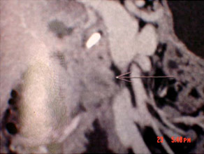 CT scan of Chronic pancreatitis with cancer