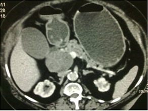 CT scan of Solid pseodopapillary tumor in pancreatic head