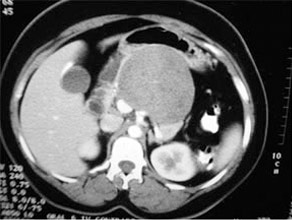 Solid pseudopapillary tumor in 

pancreatic body