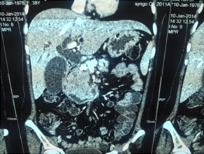 >CT scan of chronic pancreatitis with large tumor, stones in the pancreatic duct