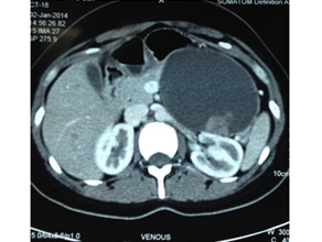 CT scan of large mucinous cystic tumor with a solid component in pancreatic body