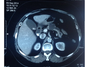 CT scan of main duct Intraductal Papillary Mucinous Neoplasm (IPMN)