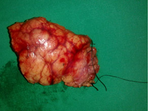 Central pancreatectomy specimen of Main duct IPMN