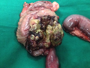 Chronic pancreatitis with fungating tumor (specimen)