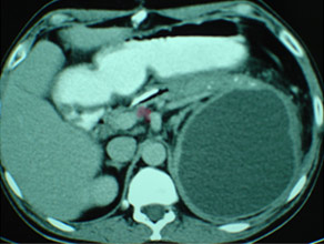 Chronic pancreatitis with large pseudocyst