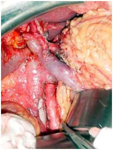 Intra operative photo after radical resection