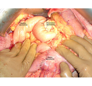 Intraoperative photo showing all the anastomosis