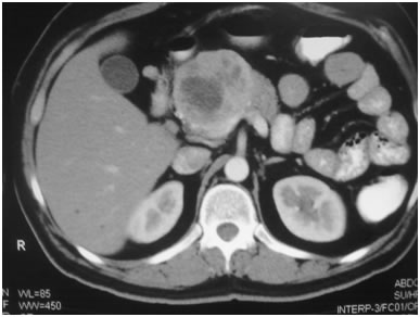 Large Neuroendocrine tumour in pancreatic head