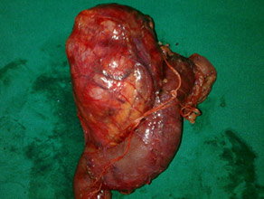 LLarge solid pseudopapillary tumor in pancreatic head