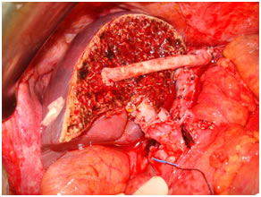 Living donor Liver transplantation