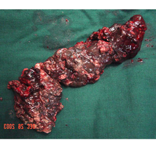 Necrotising pancreatitis Cast