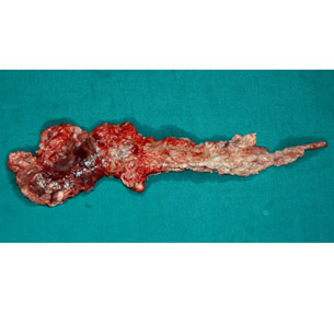 Necrotising pancreatitis specimen(infected)