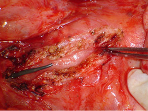 Opened pancreatic duct with stent inserted proximal to the stricture (forceps)