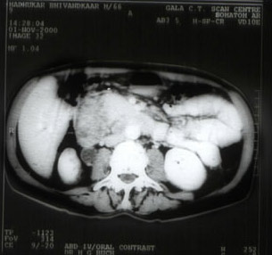 Periampullary And Pancreatic Cancers