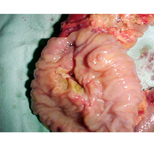 Resected specimen showing ampullary cancer