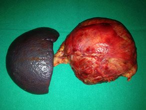 Specimen of Large cystic tumor in pancreatic body