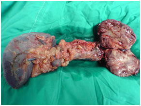 Specimen of Solid pseudopapillary tumor in pancreatic body