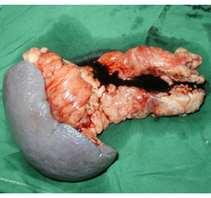 Specimen of distal pancreatectomy spleenectomy for cancer