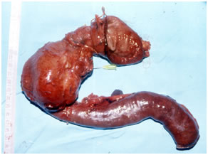 Specimen photo after radical resection for pancreatic cancer