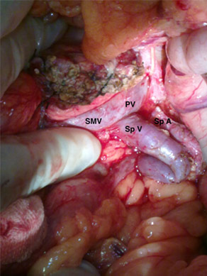 Vessel and Spleen preserving pancreatectomy