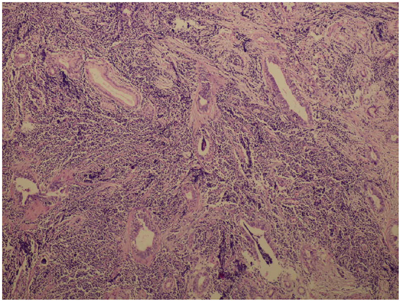 H & E staining showing both NEC and adenocarcinoma component
