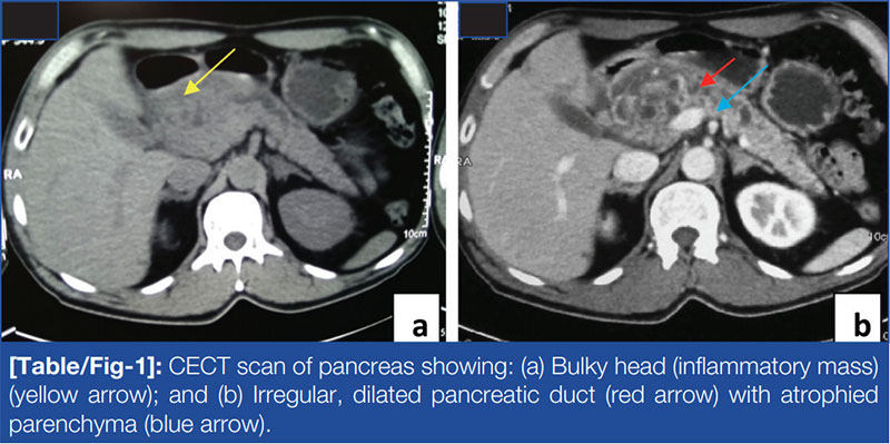 CECT scan of pancreas