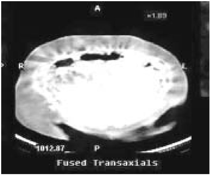 SPECT co-registered with axial CT showing localized increased uptake in jejunal mesentery 