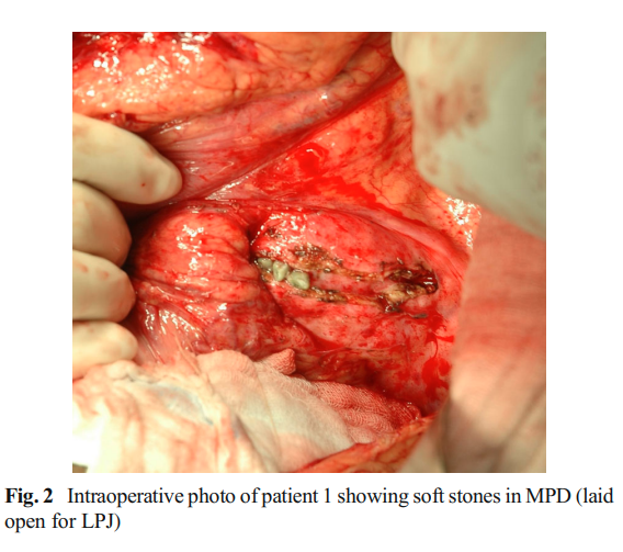 Intraoperative photo of patient 1 showing soft stones in MPD