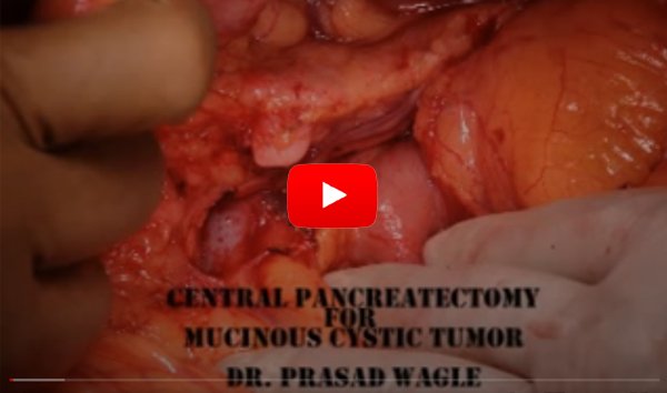 Open Inguinal hernia surgery