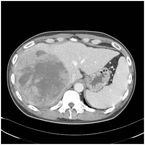 Hepatocellular Carcinoma (HCC)