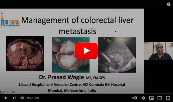 Multimodal Management of metastatic liver cancer from colon cancer and rectal cancer (CRLM)