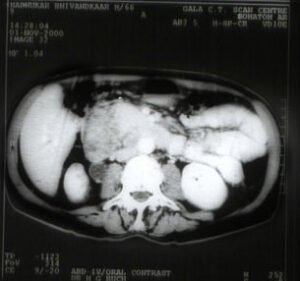 Periampullary And Pancreatic Cancers

