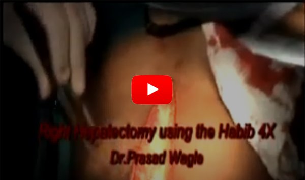Right Hepatectomy using the Habib 4x forcep