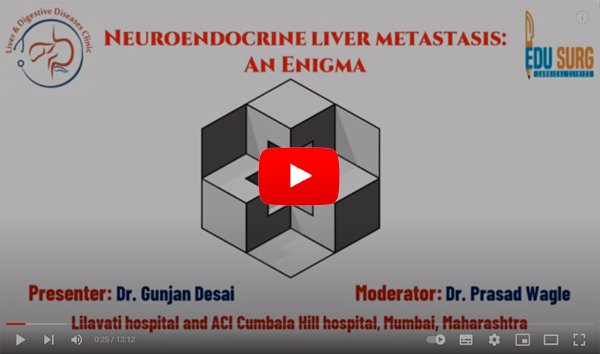 Small intestinal neuroendocrine neoplasm with liver metastasis – A case based discussion