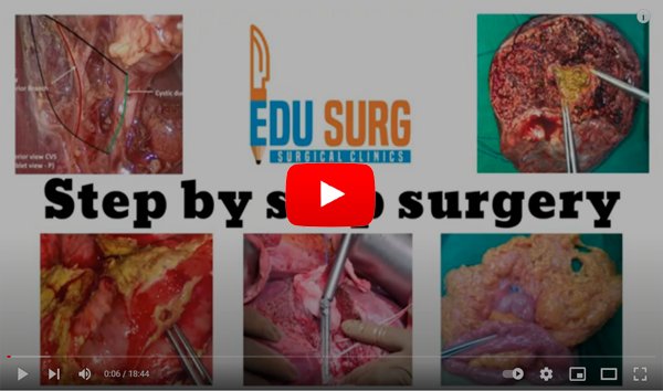 Step by step pancreatic cancer surgery I Whipple procedure I Pancreaticoduodenectomy