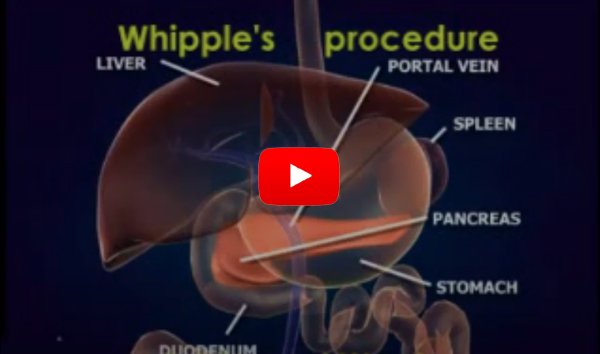 Whipples Procedure