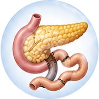 Pancreaticoduodenectomy