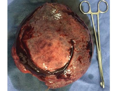 Gross tumor