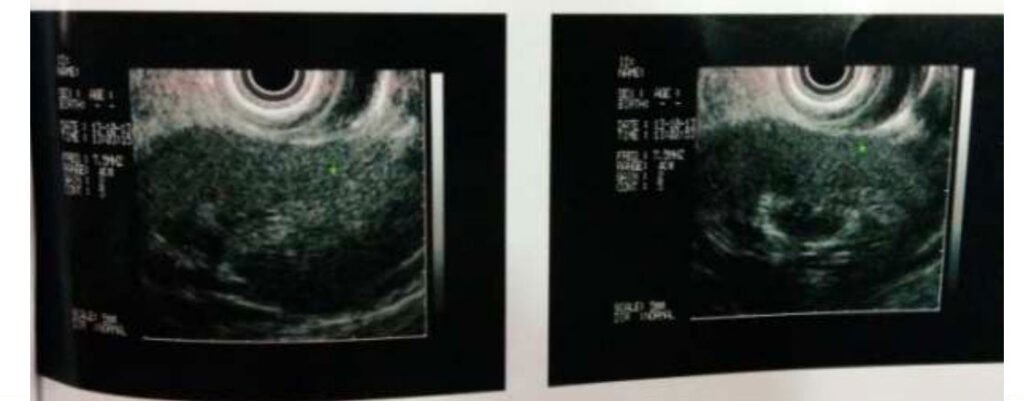 Hypoechoic lesion