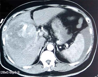 hemoperitoneum, arterially enhancing lesion